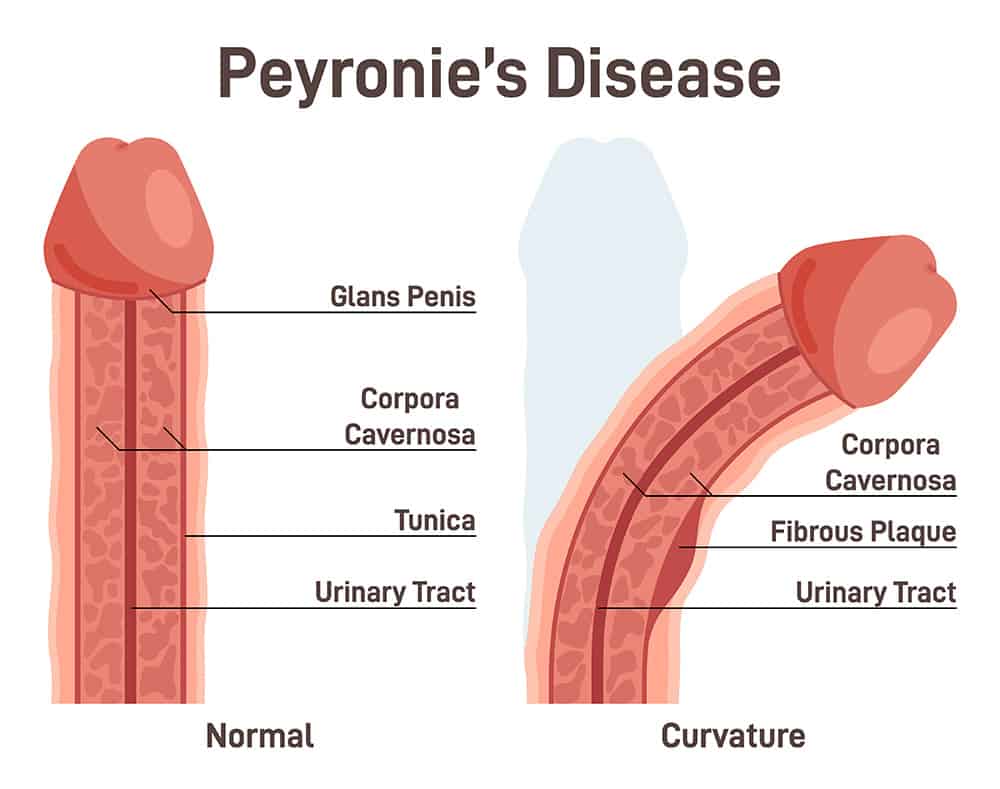 Peyronies Disease